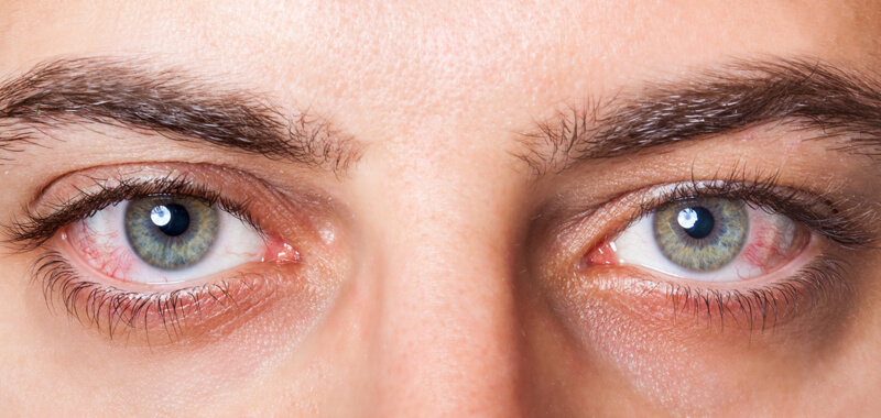 Keratitis: Gejala, Penyebab, Pengobatan, dan Pencegahan