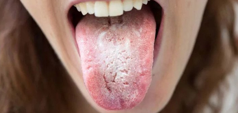 Candidiasis Mulut: Gejala, Penyebab, dan Pengobatan