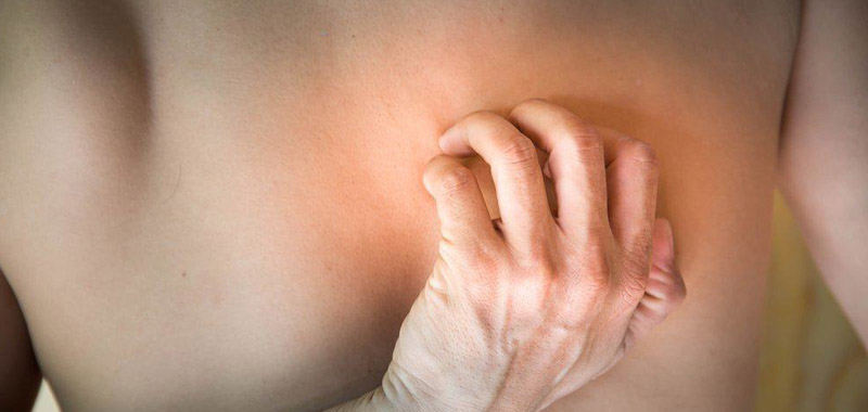 Panu (Tinea Versicolor): Penyebab, Gejala, dan Pengobatan