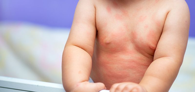 6 Penyebab Alergi pada Bayi dan Cara Mengatasinya