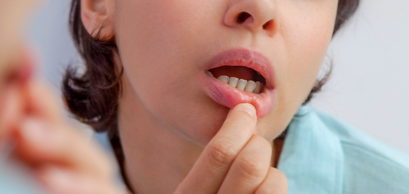 Sariawan: Gejala, Penyebab, dan&nbsp;Pengobatan