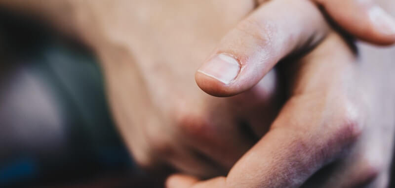 Kusta: Gejala, Penyebab, dan&nbsp;Pengobatan