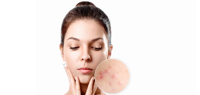 Penyebab dan Cara Mengatasi Jerawat Meradang